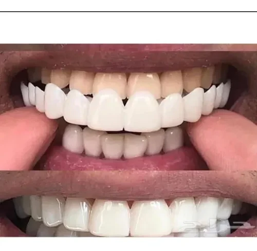 Sorriso Perfeito™️ Dentaduras removíveis (Kit superior + inferior)